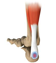 Achilles Tendon Bursitis