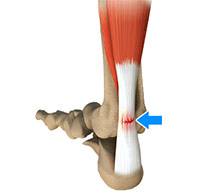 Achilles Tendon Rupture