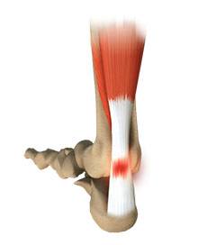 Achilles Tendonitis