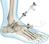 Ankle Arthroscopy