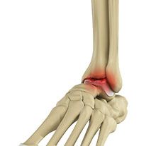 Arthritis of The Foot & Ankle