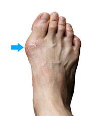 Bunion Surgery