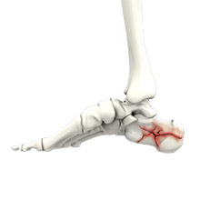 Foot Fracture