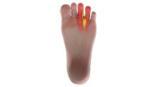 Neuroma