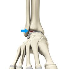 Osteochondral Injuries of The Ankle