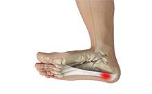 Plantar fasciitis and Bone Spurs