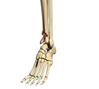 Shinbone Fracture