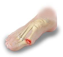 Stiff Big Toe Hallux Rigidus