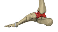 Talus Fracture